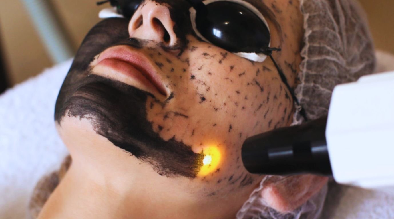 Peeling de Carbono: El Tratamiento Que Está Revolucionando Valencia